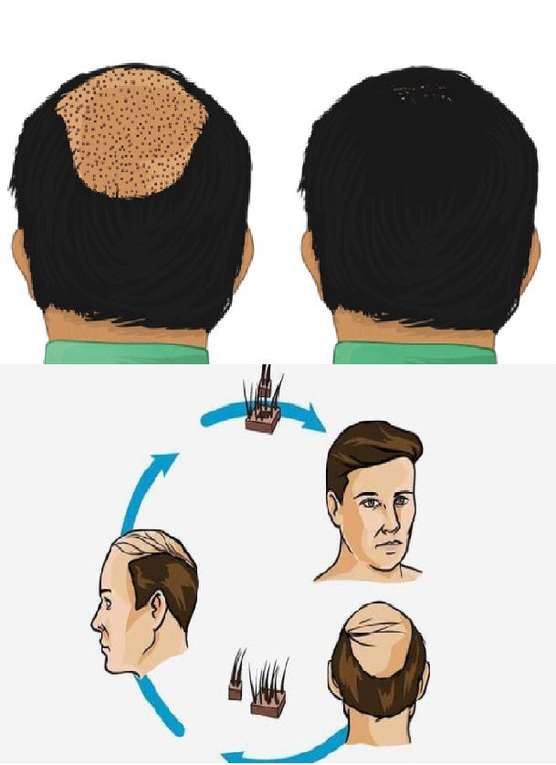 Best Hair Transplant clinic Pune | Lowest Cost | EMI Best Hair Transplant clinic Pune | Lowest Cost | EMI
